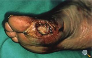 Diabetisches Fusssyndrom